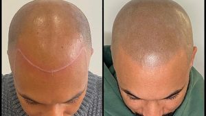 G&G Micropigmentation Capillaire - Tricopigmentation - traitement calvitie