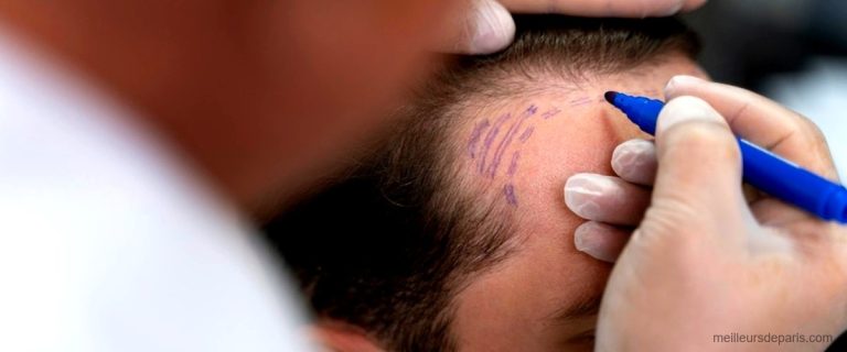 Les 11 meilleures cliniques de greffe capillaire à Paris